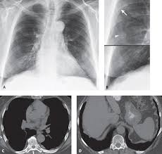There is no direct link between the presence of plaques and the development of other diseases such as asbestosis, diffuse pleural thickening, lung cancer or . 173 Asbestos Related Pleural Plaques Radiology Key
