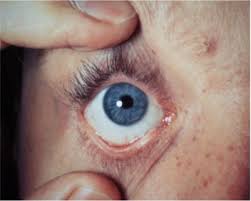 A quick tutorial on how to flip the upper eyeli… read more eyelid flip ~ a primer on ptosis. Examining The Eyes