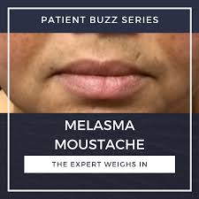 Image result for Melasma