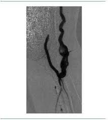 La trombosis arterial también puede ocurrir en arterias coronarias que drenan sangre al tejido del músculo cardíaco. Embolismo Arterial De Fistula Arteriovenosa En Paciente En Hemodialisis Nefrologia