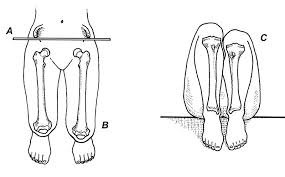 Image result for Functional Leg Length Discrepancy