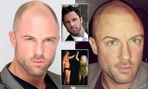 Man, 33, swaps £16 'hair in a can' for tattoos that cover his bald spot