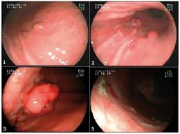 Your lungs or your digestive system, also known. Gastrectomia Laparoscopica En Carcinoide Gastrico