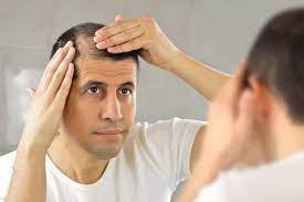 Yuk simak cara mengatasi rambut rontok pada pria secara alami maupun medis di sini! 5 Hal Yang Bisa Jadi Penyebab Rambut Rontok Halaman All Kompas Com