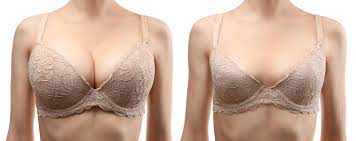 Große Brüste: Ursachen, Symptome & Behandlung | Plastica