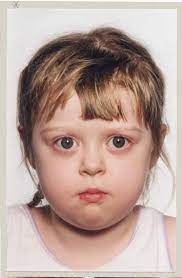 It is by far the most common cause of hyperthyroidism in children. Graves Disease Paediatrics And Child Health