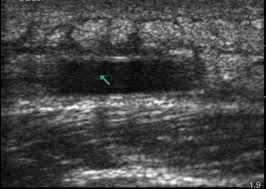 How long is the wait? The Role Of Ultrasound For Soft Tissue Infections In The Urgent Care Setting Journal Of Urgent Care Medicine