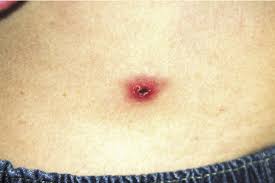 Here are pictures of what a tick look like on a dog: Typical Coarse Maculopapular Rash Of Tick Bite Fever Photo Dr B Miller Download Scientific Diagram