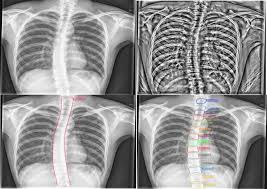 The first rib is attached to thoracic vertebra. Evaluation Of A Computer Aided Method For Measuring The Cobb Angle On Chest X Rays Springerlink