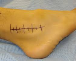 The injuries can comprise either soft tissue tears, avulsion fractures or both. Grade Iii Ankle Ligament Sprain Surgery Vs Bracing