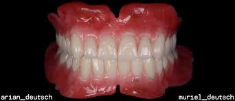 A partial denture is different from a full upper or lower plate in that for some, the cost of permanent dentures, or any other types of false teeth option, is way out of their and there are many options for styles and materials available… many of which may be more. Permanent Denture Options Pros Cons Beverlyhillsladetist Com