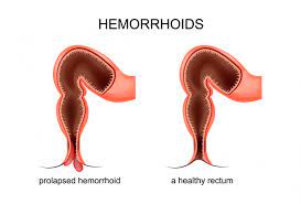 The unqualified term hemorrhoid is often used to refer to the disease. Piles Causes Symptoms Diagnosis And Treatment Health Library