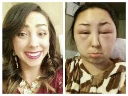 More severe reactions however, can be much more detrimental. Want To Dye Your Hair This Crazy Allergic Reaction Might Put You Off Shemazing