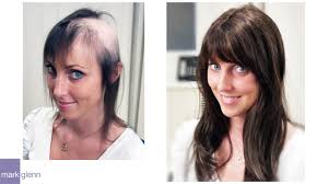 Female Hair Loss Replacement Kinsey System For Hair Loss In Women Mark Glenn Hair Enhancement Mayfair London Uk