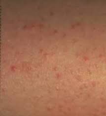 Image result for Keratosis pilaris