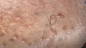 Guinness world records published the first book of world records in 1955. Guinness World Record Longest Ingrown Hair New Pimple Popping Videos