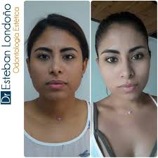 La bichectomia según expertos, es el tratamiento quirúrgico con el que se logran las mejillas perfectas o bien afiladas, como esas famosas que han puesto de moda este ¿que es la bichectomia?; Procedimiento De Bichectomia Estiliza Tu Rostro Define Los Pomulos Intervencion Minimamente Invasiva De 30 A 45 Min Bichectomia Disenos De Sonrisa Estetica