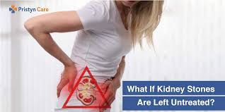 What If Kidney Stones Are Left Untreated Pristyn Care