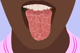 Check spelling or type a new query. Dry Mouth And Arthritis Tips For Coping With It