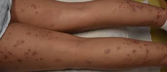 Image result for Photodermatitis