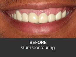 Left unchecked, the gingiva or gums can recede considerably to the point of. Https Encrypted Tbn0 Gstatic Com Images Q Tbn And9gcri8z3ojvouxf M5o85c0ieq8tsgqvnkrkffw Usqp Cau