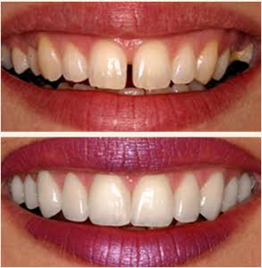Smile designing product image