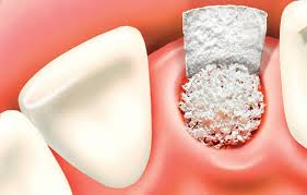 Bone Grafting For Dental Implants Dentalcareplus