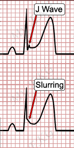 Image result for Early Repolarization