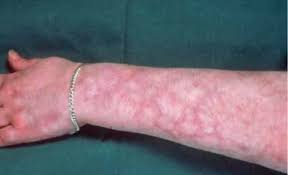 The Appearance Of Mottled Skin As Seen In Many Patients Livedo Reticularis Fibromyalgia Rash Autoimmune Disease Symptoms