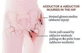 Pin On Hip Pain