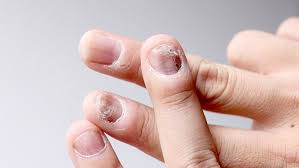 Image result for Akutní zánět nehtového lůžka