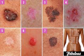 can you spot which moles are deadly the skin cancer signs