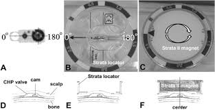 The codman hakim programmable valve offers the ability to optimize the opening pressure of a shunt system before and after implantation. Programming Jammed Codman Hakim Programmable Valves Study Of An Explanted Valve And Successful Programming In A Patient In Journal Of Neurosurgery Pediatrics Volume 12 Issue 2 2013