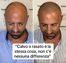 Calvo o rasato? #marcocanepa #tricometodo #tricopigmentazione #trapia...