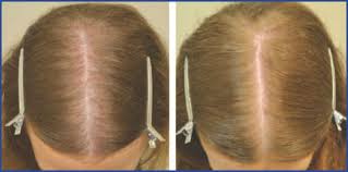 Hysterectomy means the surgical removal of the uterus (womb) and is still one of the most common operation. Medical Therapy For Female Pattern Hair Loss Fphl Hair Transplant Forum International