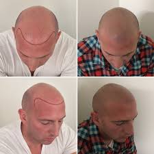 Prp hair loss treatment in melbourne. Scalp Micropigmentation Hair Loss Solution Melbourne Sydney