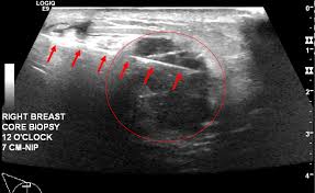 Mri, mammogram, and ultrasound tests are needed to diagnosis inflammatory breast cancer. Cureus Pitfalls Of Breast Evaluation In The Emergency Department