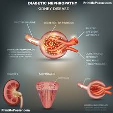 1124 patients with renal disease, 566 with diabetes, both types. Diabetic Nephropathy Kidney Disease Poster Poster Printmeposter Mousepad Tshirt Diabetic Nephropathy Nephropathy Kidney Disease
