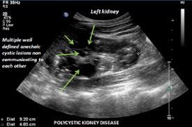How is chronic renal failure treated? Ultrasound Appearance Of Congenital Renal Disease Pictorial Review Sciencedirect