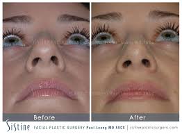 Dermatologists have the education, expertise and experience to safely and effectively reduce the signs of aging. Rhinoplasty Pittsburgh Nose Surgery Facial Plastic Surgeon Dr Paul Leong
