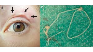 So capture one and sent it to the local if this doesn't work, then the inside of the drain pipe and plumbing trap might need to be cleaned with a brush. A Mosquito Bite A Parasitic Worm A Nightmarish Scenario Goats And Soda Npr