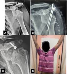 Image result for Chronic Shoulder Dislocation
