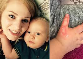 Mum Warns Of Hoovering Dangers After Baby Boy Suffers Painful Burns