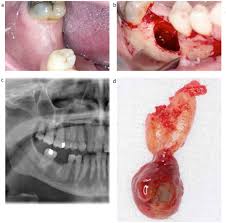 Odontogenic Cysts An Overview Dental Update