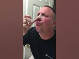 nose packing removal