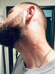 4 lymph nodes on the back of my neck are swollen and sore to touch. Here S A Update To How My New Enlarged Lymph Nodes Look Got Quite Bigger In The Past Week The Scar You See Is A Lymph Node That Was Removed Back In January