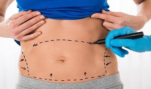 Circumferential Abdominoplasty in Islamabad & Pakistan