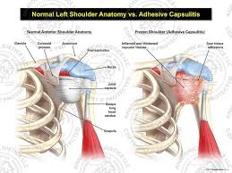 Select from premium shoulder anatomy images of the highest quality. Normal Left Shoulder Anatomy Vs Adhesive Capsulitis