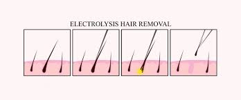 Electrolysis and lasers are popular hair removal methods that can remove hair on most areas of the body. Is Electrolysis Hair Removal Painful 2pass Clinic