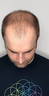 It wouldn't turn me off if a guy i met told me he has one. Mens Hair 2 Go Hair Systems Uk Mens Hair Replacement Hair Systems London